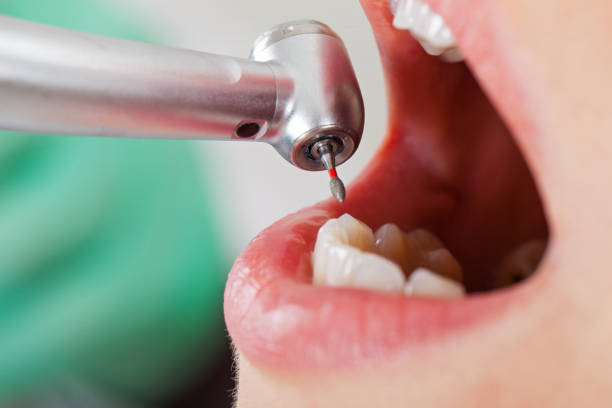 Best Emergency Dental Extractions in Garland, TX
